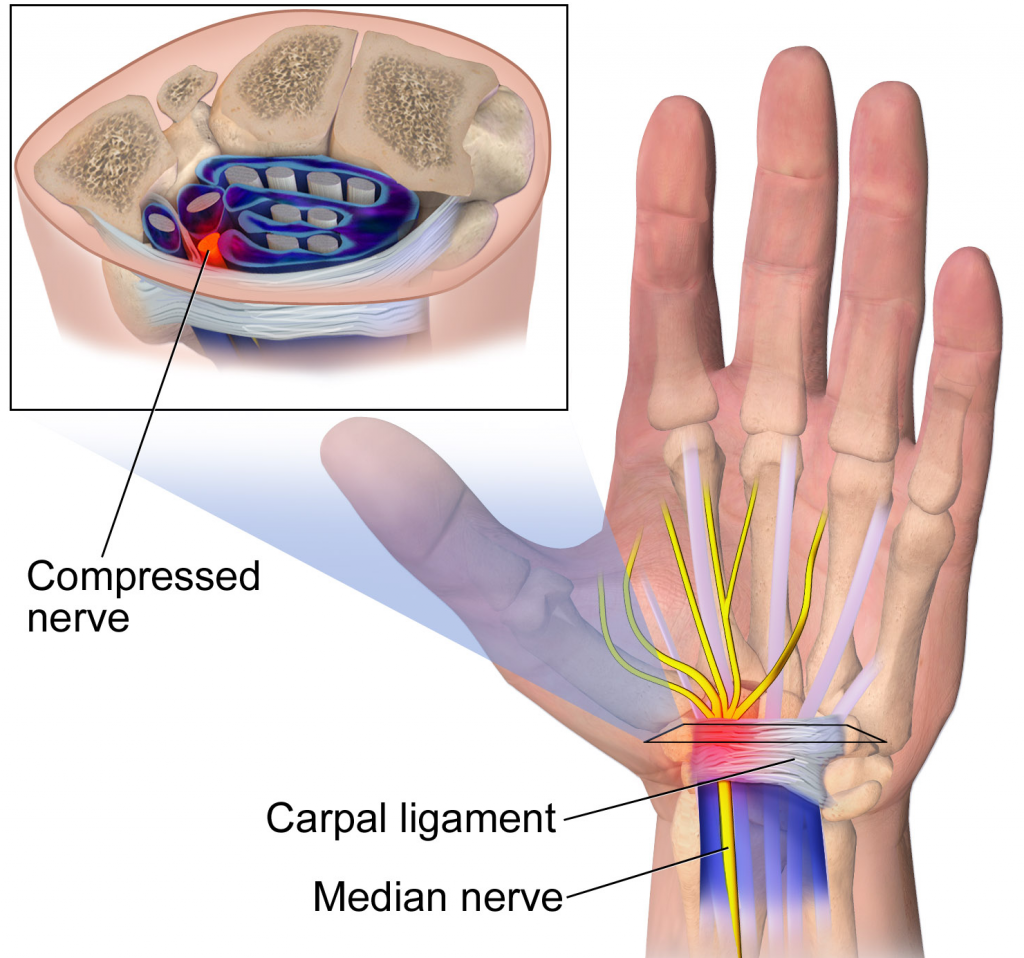 What Do They Put On Your Hand After Carpal Tunnel Surgery