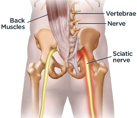 Sciatica Symptoms And Treatment